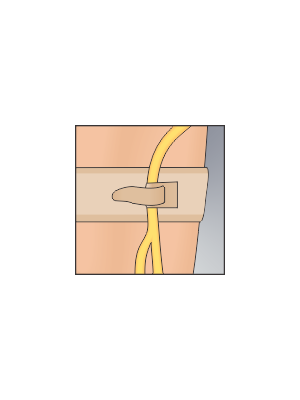 Urocare 6313 Catheter/Tubing Strap Abdominal 34